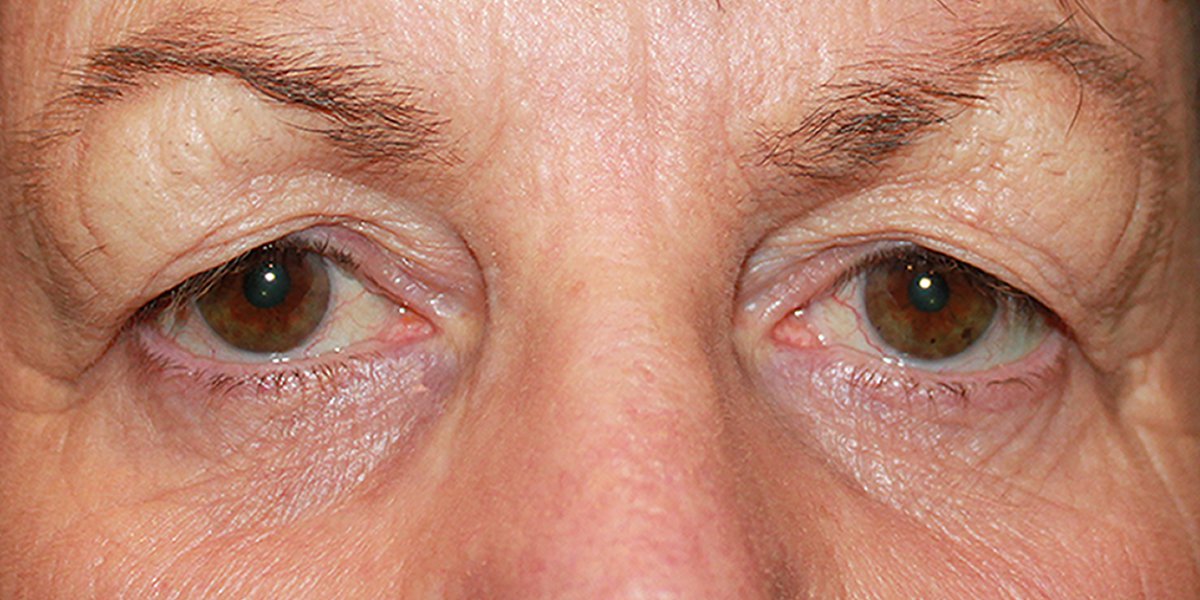 Ann - Blepharoplasty