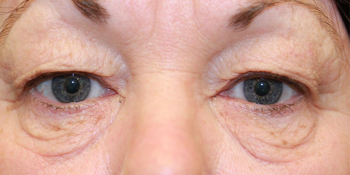 Karin - Blepharoplasty