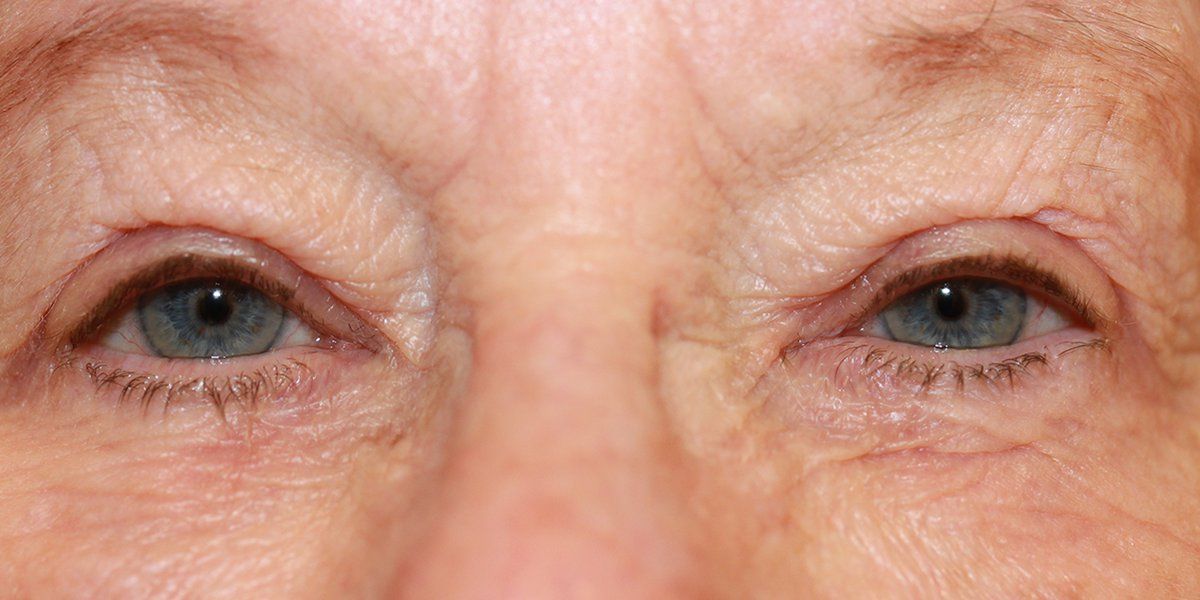 Heather - Blepharoplasty