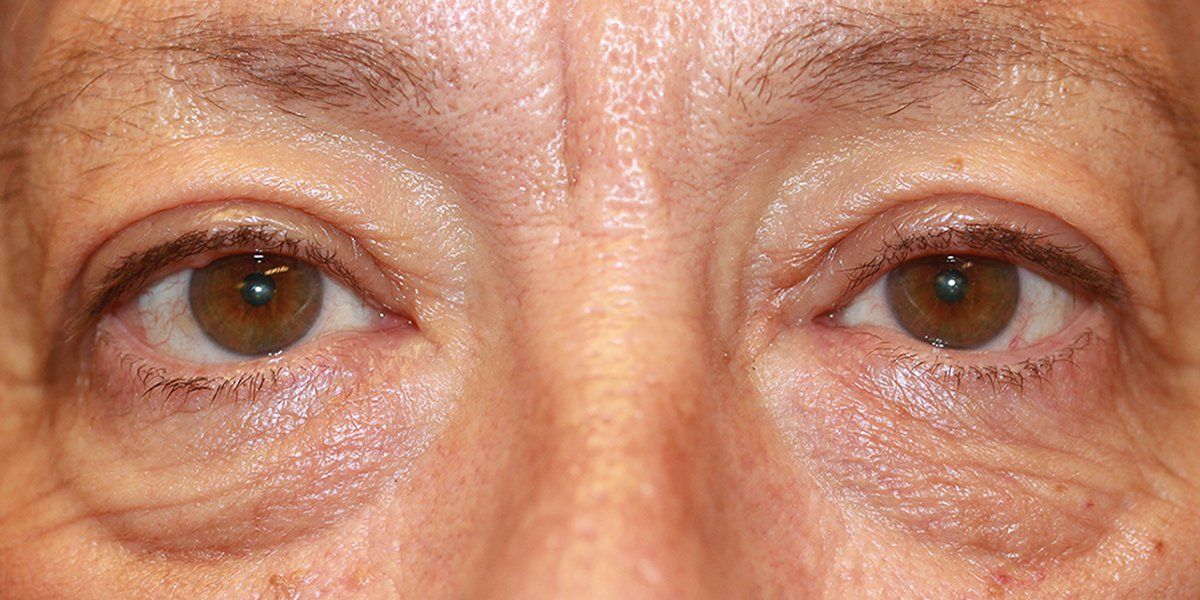 Kathryn - Blepharoplasty