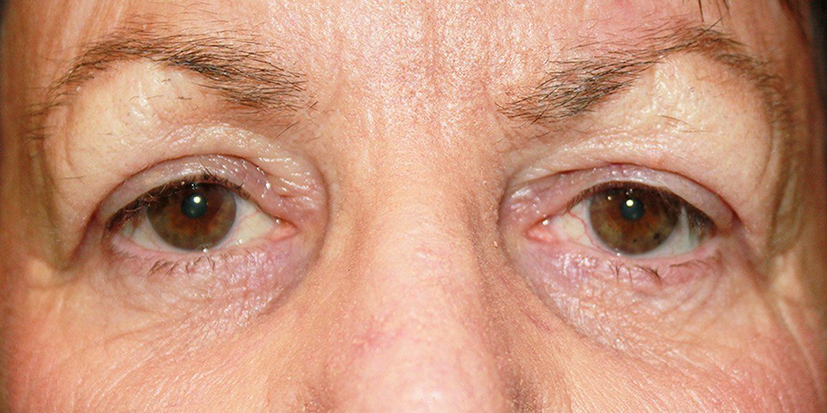 Ann - Blepharoplasty