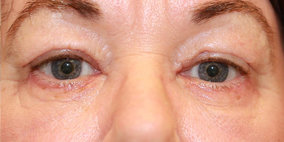 Karin - Blepharoplasty